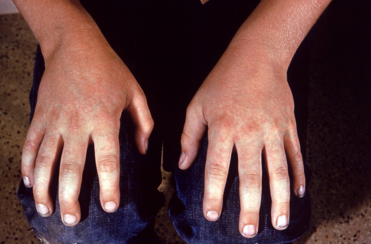 Exanthem of erythema infectiosum