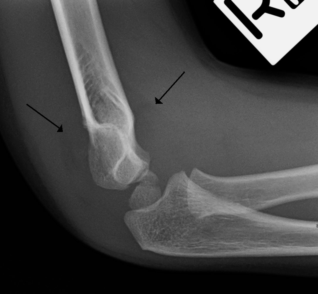 Anterior and posterior fat pad signs in supracondylar fracture