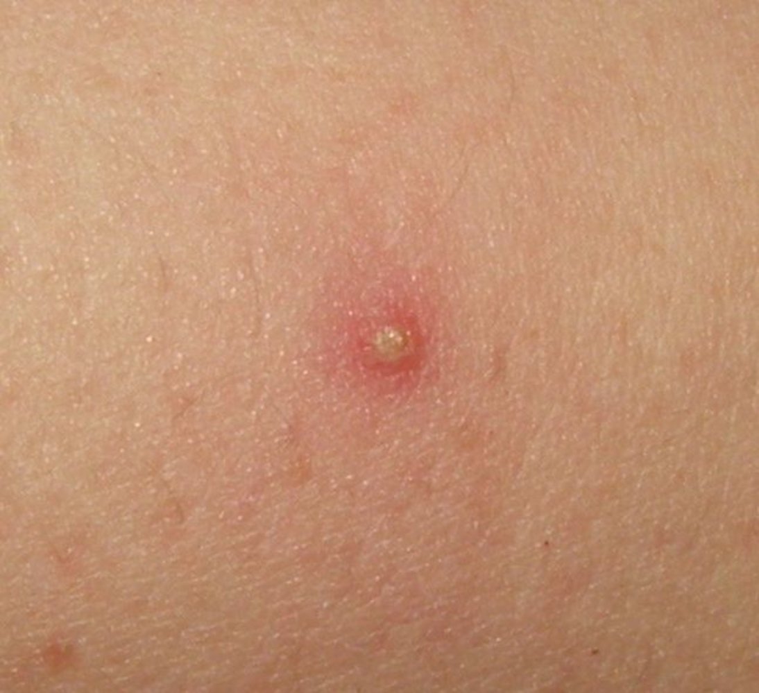 Folliculitis