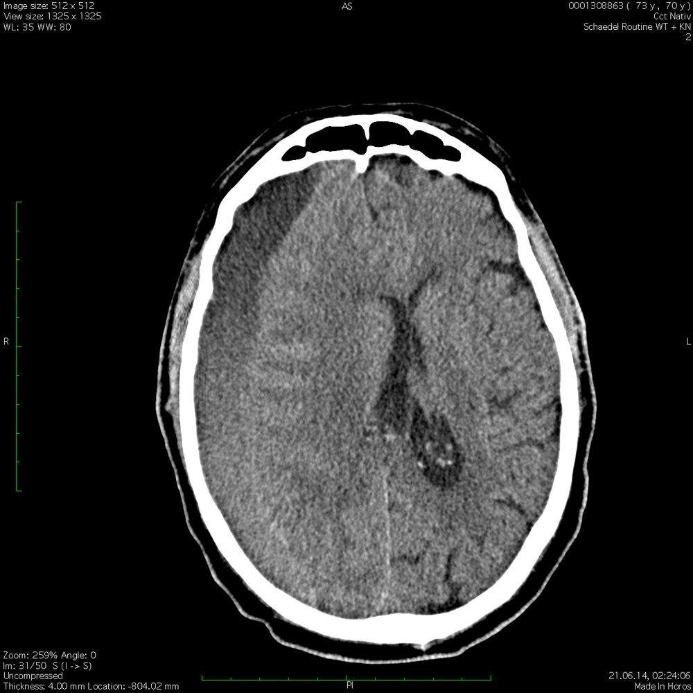 Acute-on-chronic subdural hematoma