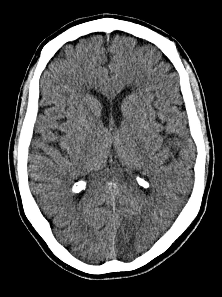 Subacute posterior cerebral artery infarct