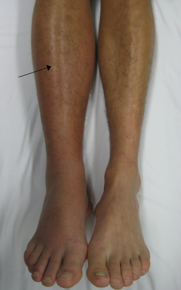 Deep vein thrombosis (DVT)