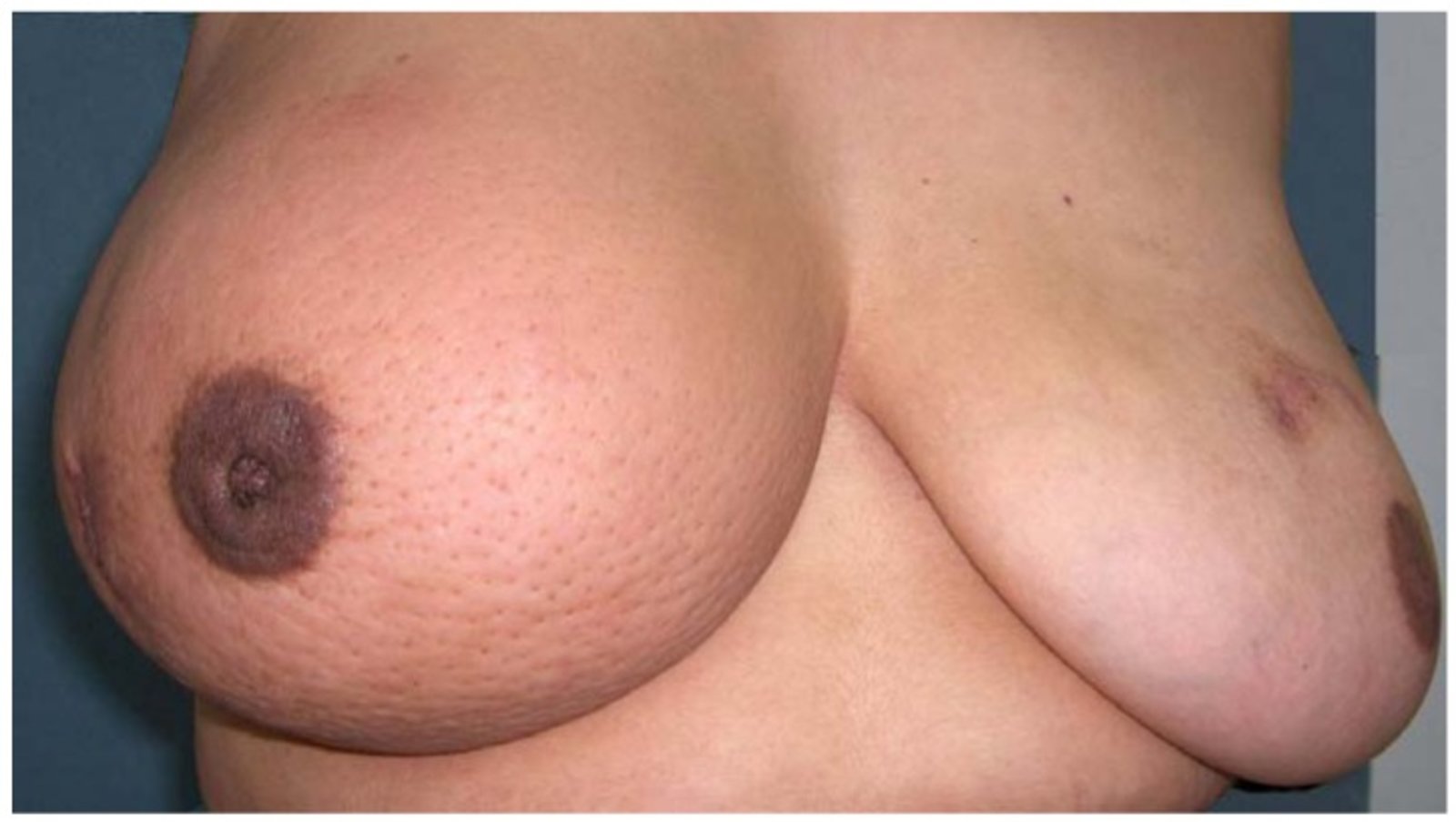 Inflammatory breast cancer
