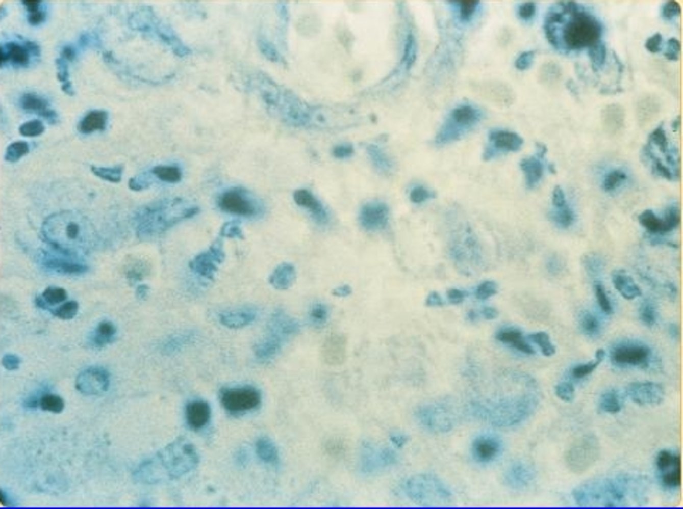 Granuloma inguinale (Donovaniosis)