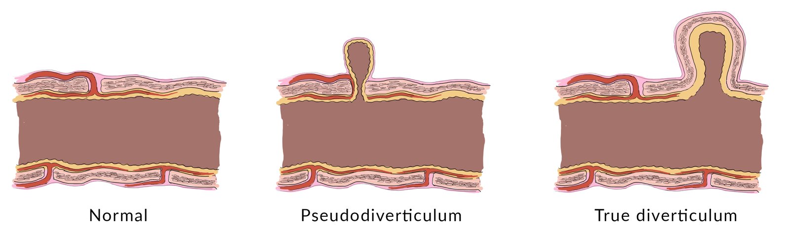True diverticula and pseudodiverticula