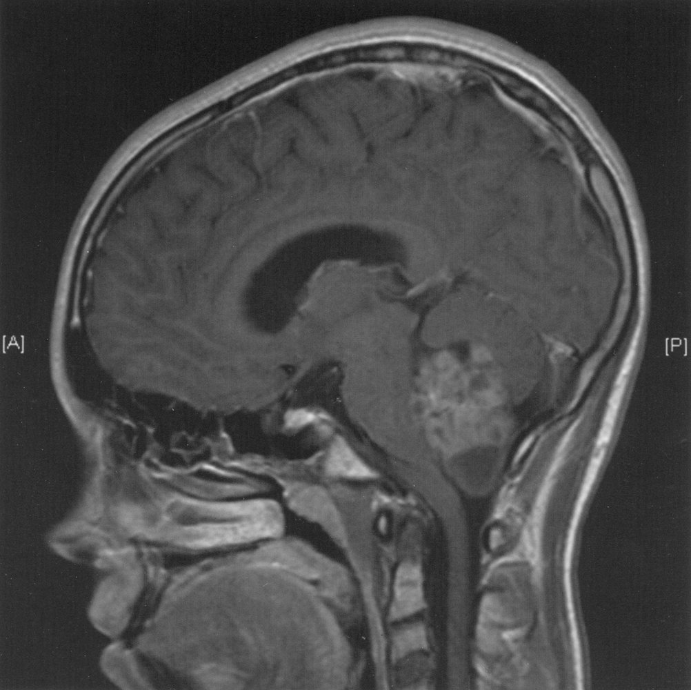 Medulloblastoma