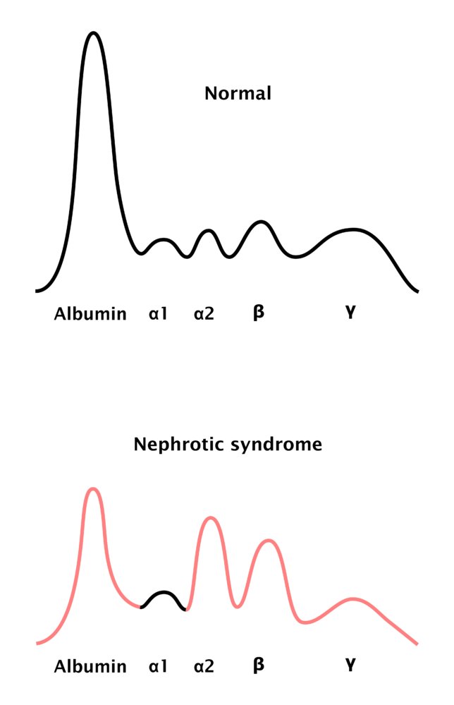 Serum protein electrophoresis in nephrotic syndrome