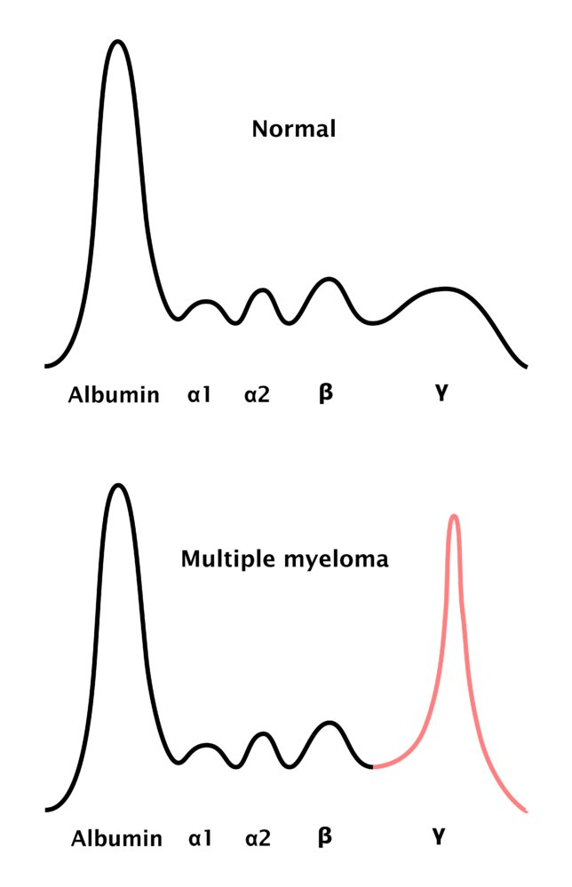Multiple myeloma - serum protein electrophoresis with M protein