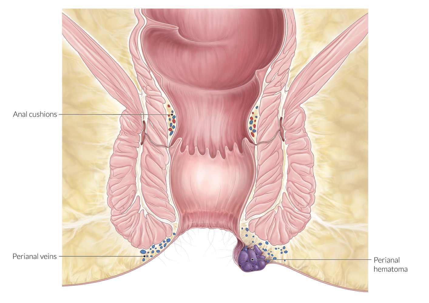 Thrombosed external hemorrhoid