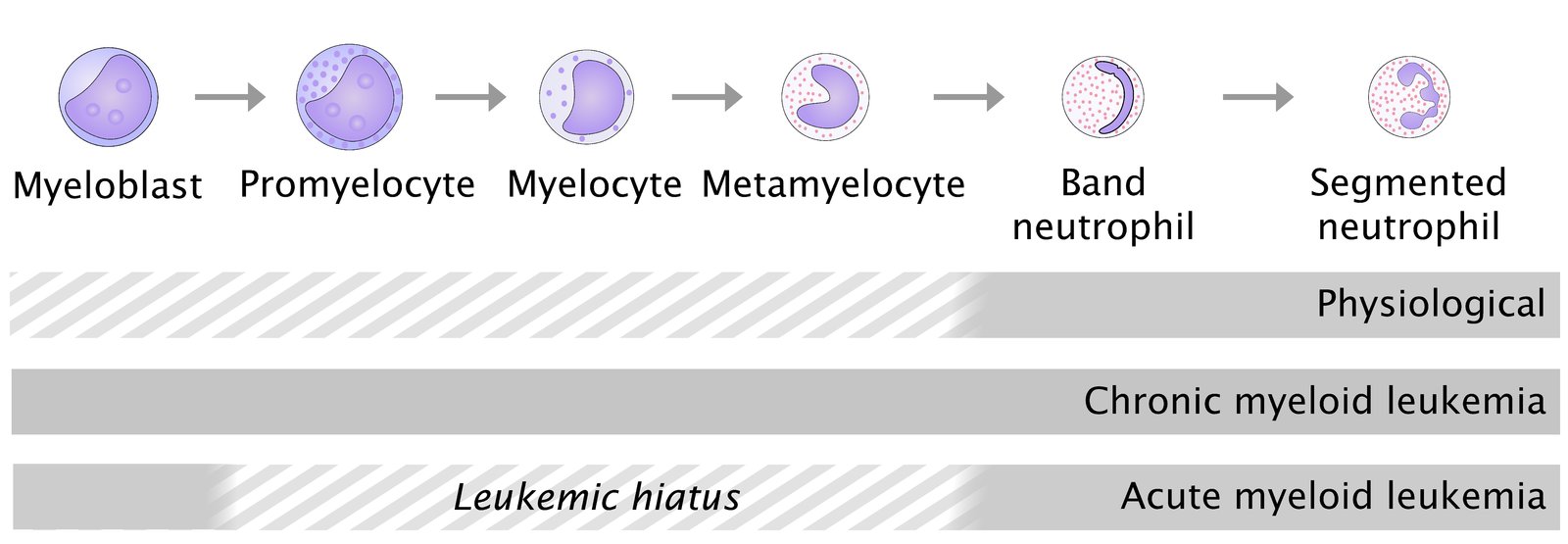 Leukemic hiatus