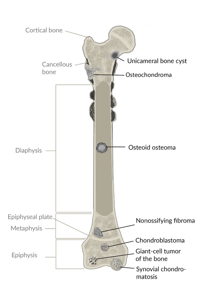 Typical location of benign tumors in the long bones