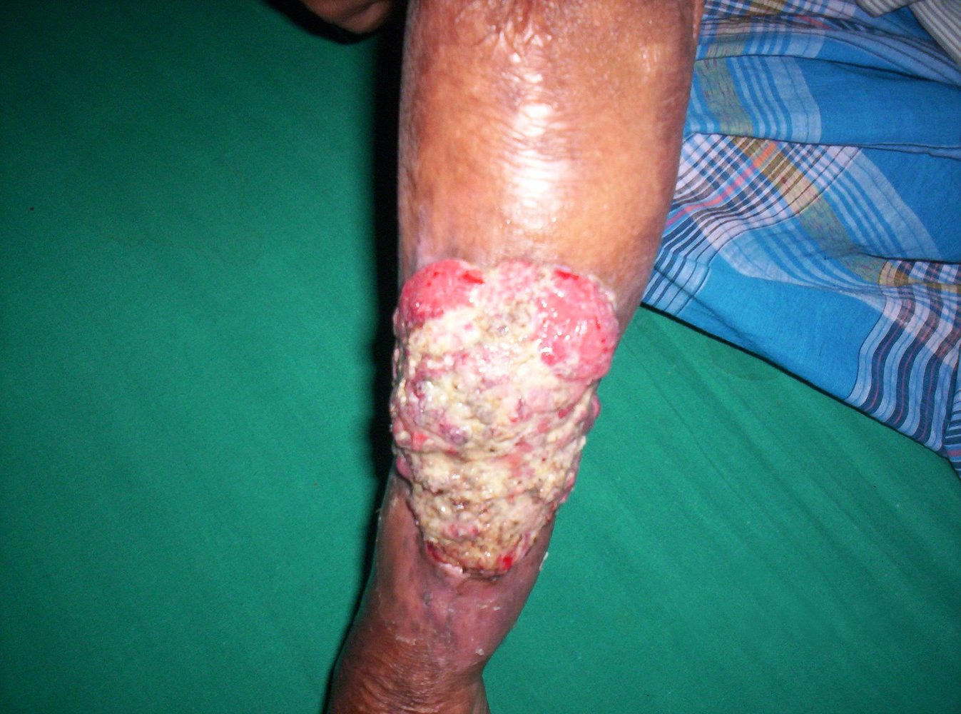 Marjolin's ulcer