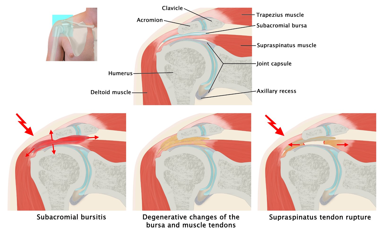 Rotator cuff tear