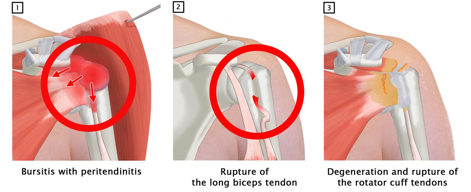 Complications of rotator cuff tendinitis