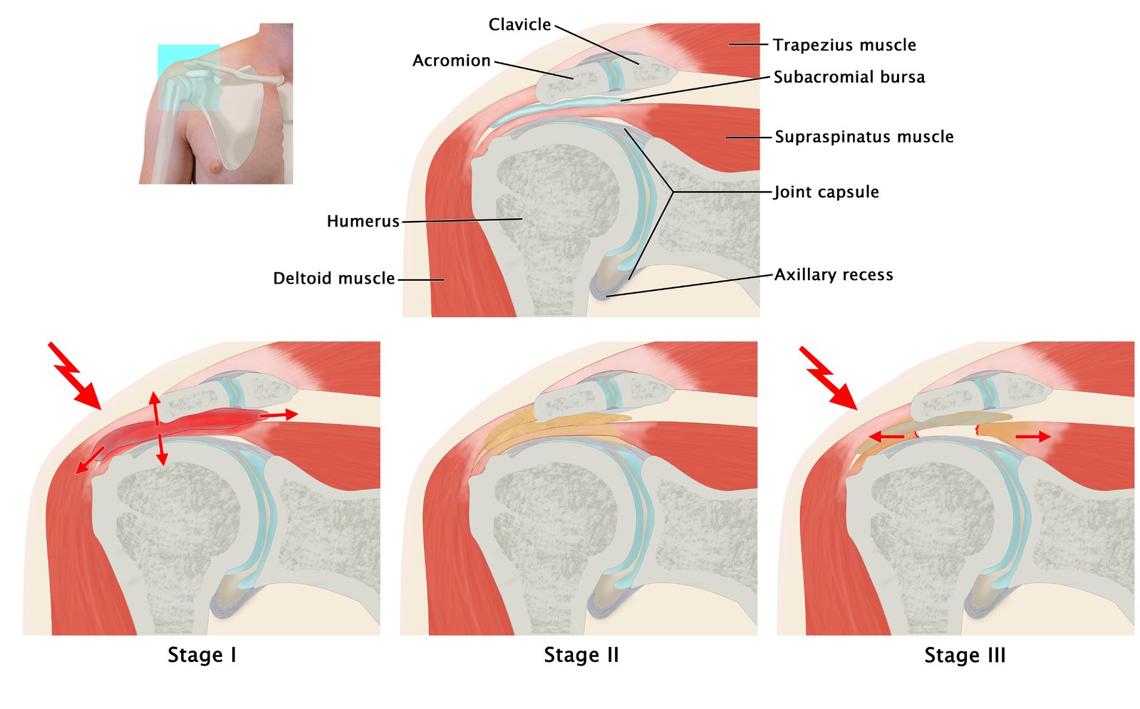 Subacromial impingement syndrome