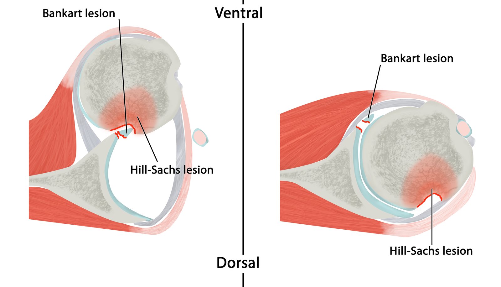 Hill-Sachs and Bankart lesion following an anterior shoulder dislocation