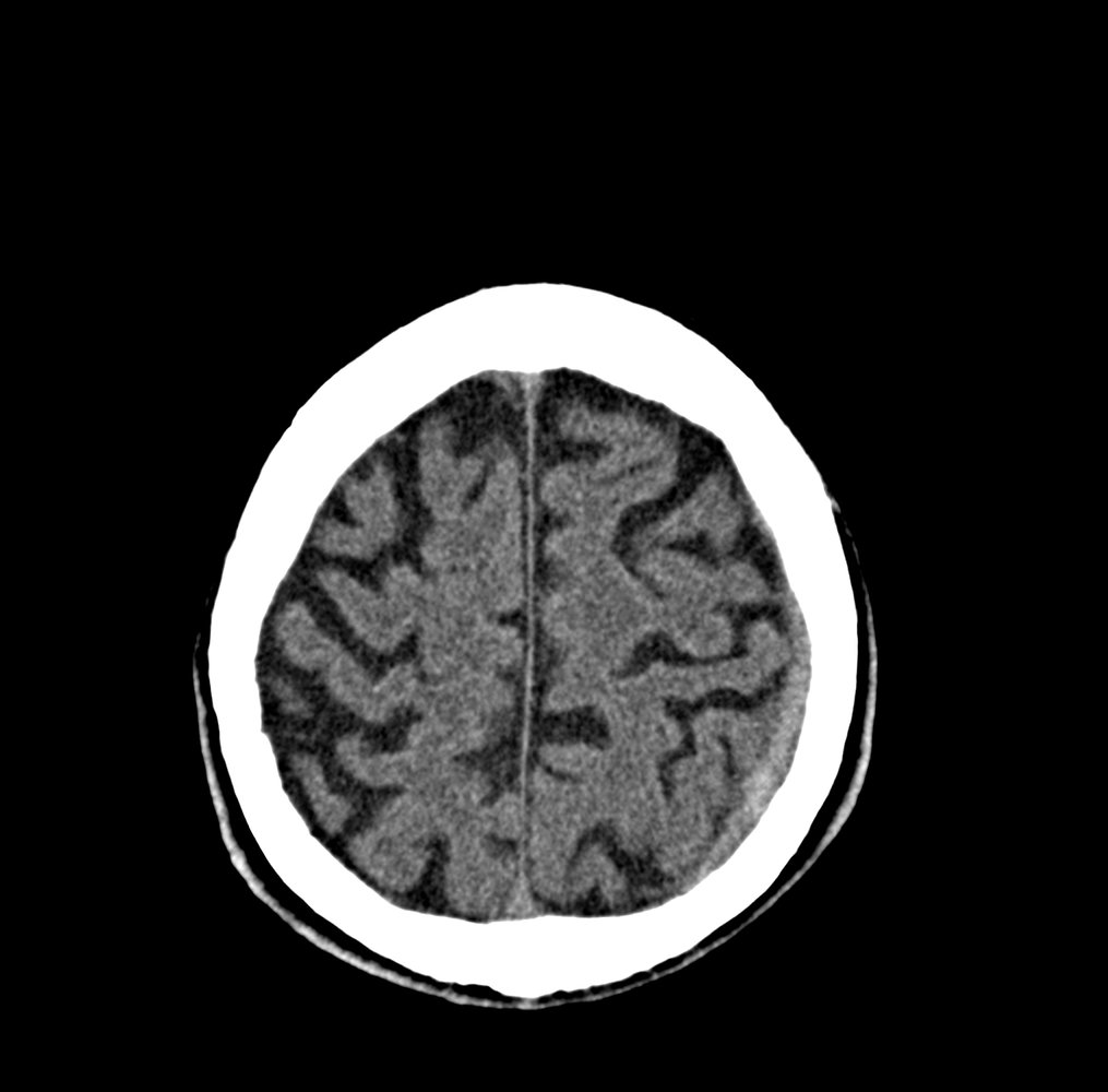 Acute subdural hematoma