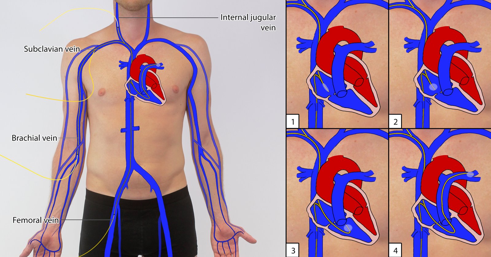 Right heart catheterization and placement of a flow-directed catheter