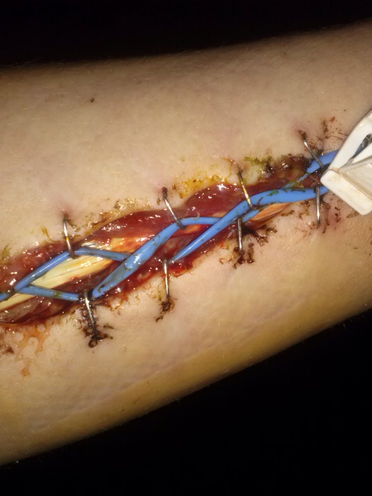 Forearm fasciotomy