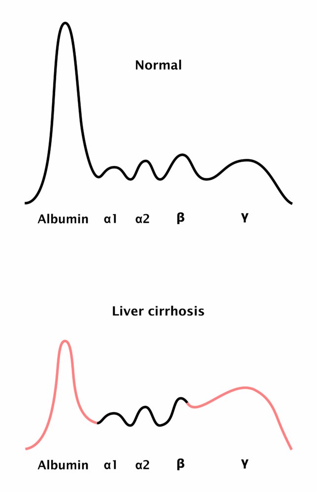 Serum protein electrophoresis in liver cirrhosis