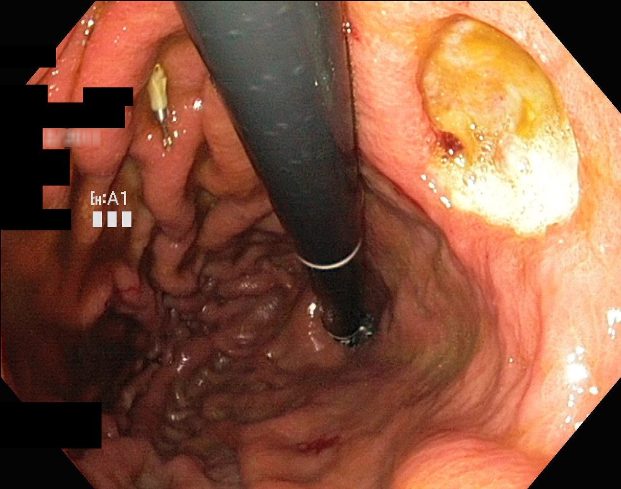 Gastric ulcer: Forrest stage IIc