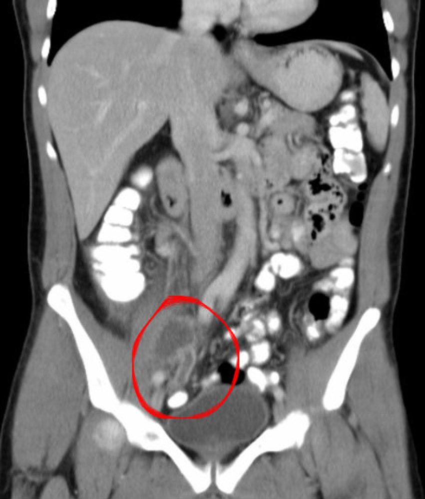 Appendiceal abscess
