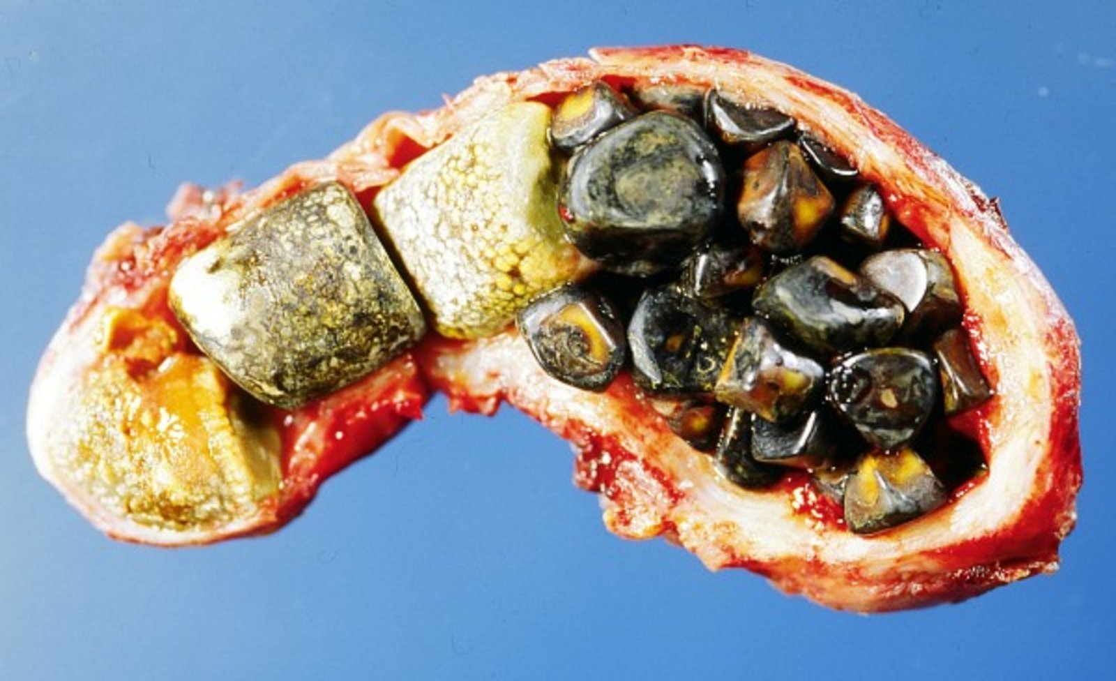 Gallbladder with stones