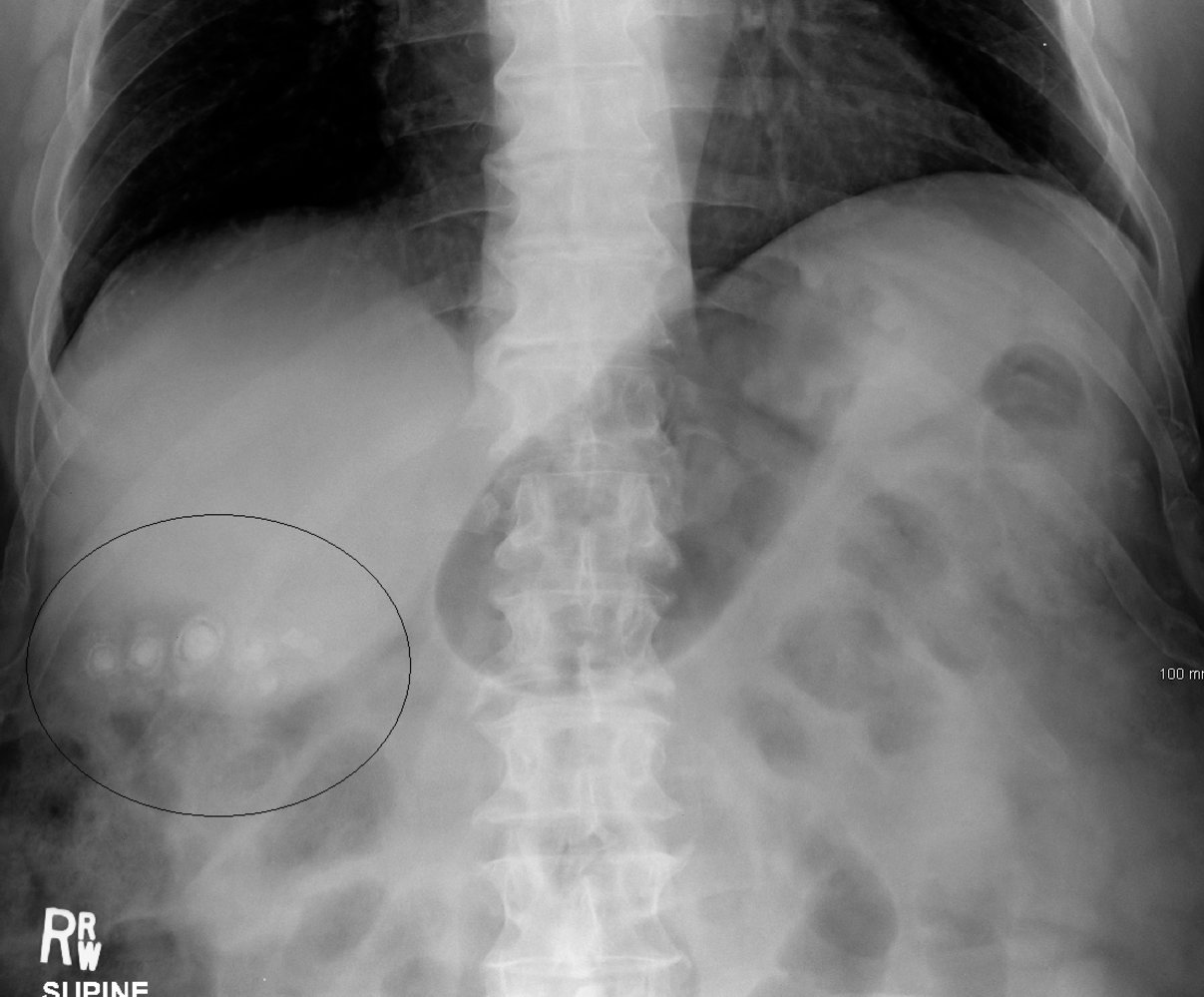 Gallbladder calculi