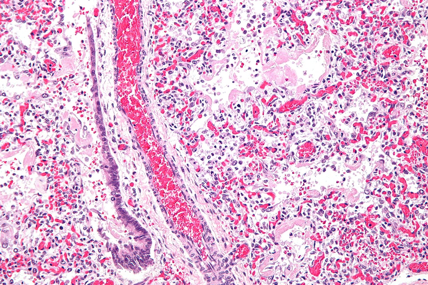 Hyaline membranes in ARDS