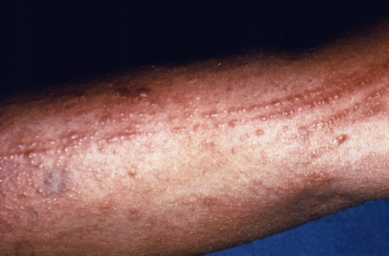Urushiol-induced contact dermatitis
