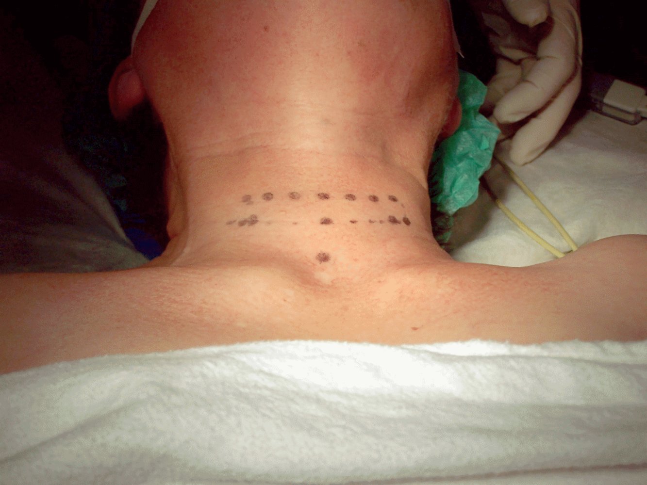 Skin incision for thyroidectomy (Kocher incision)