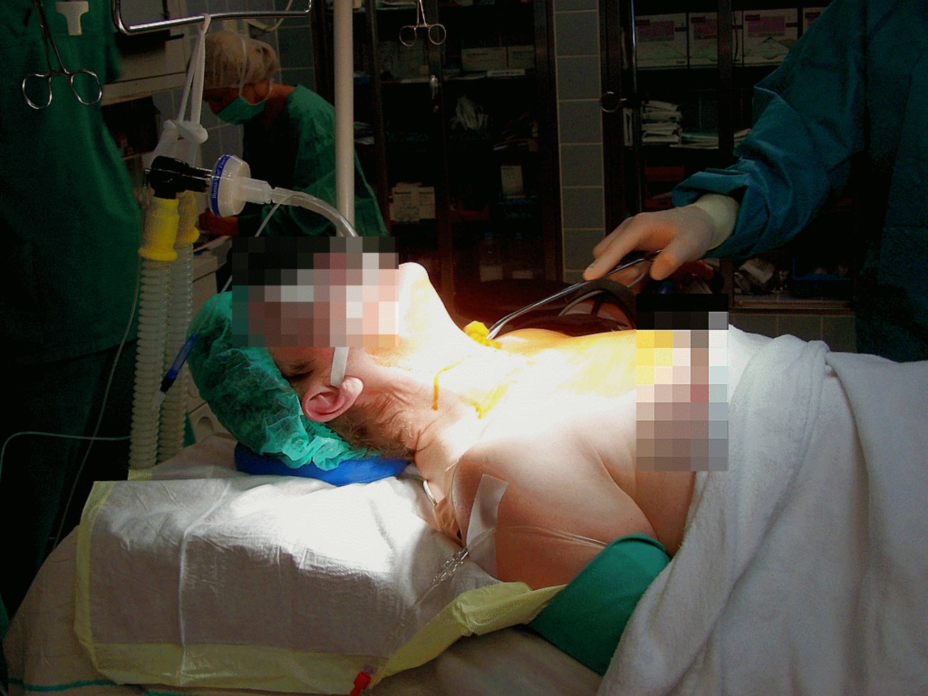 Surgical position for thyroidectomy