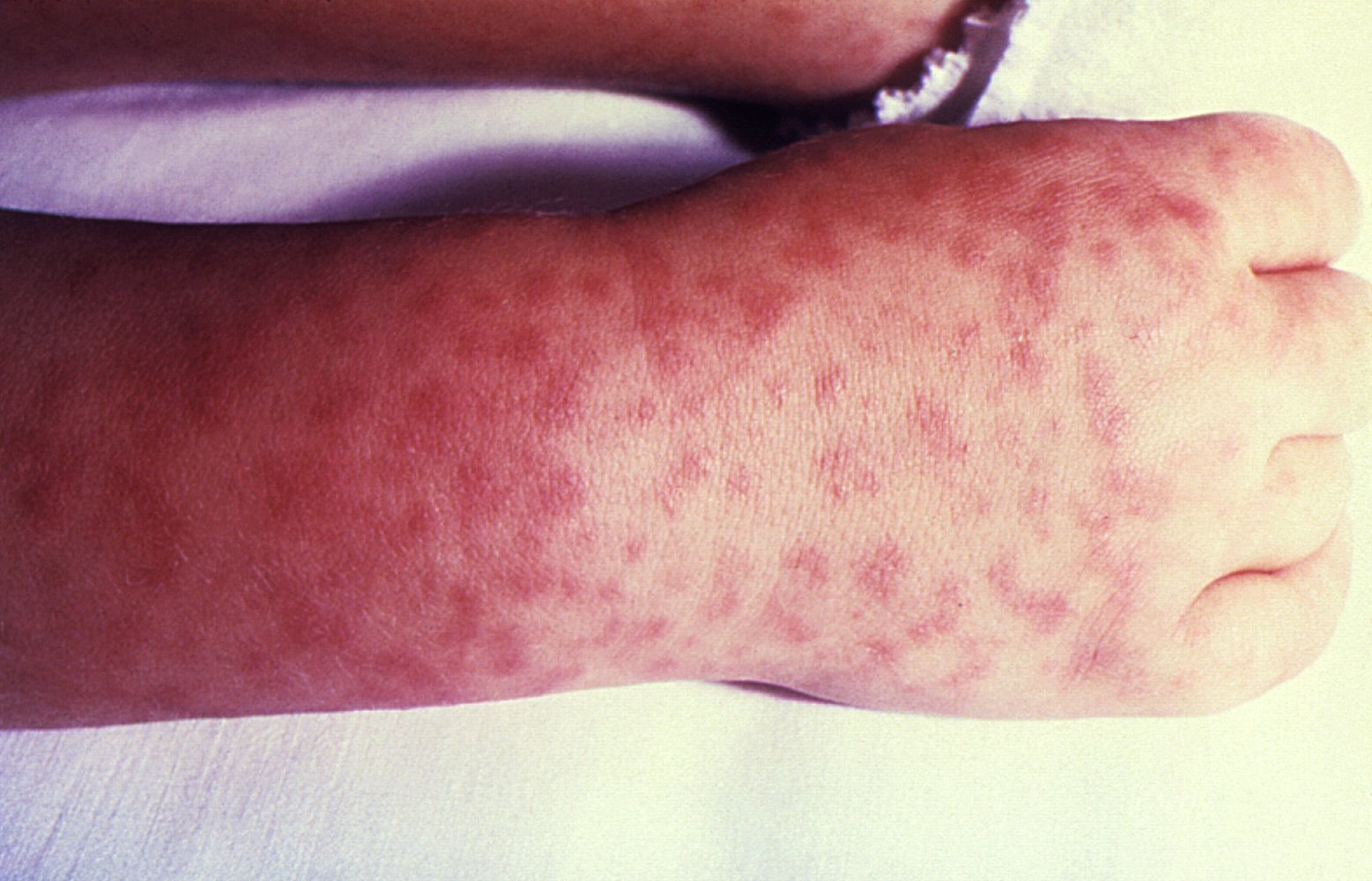 Rocky Mountain spotted fever rash