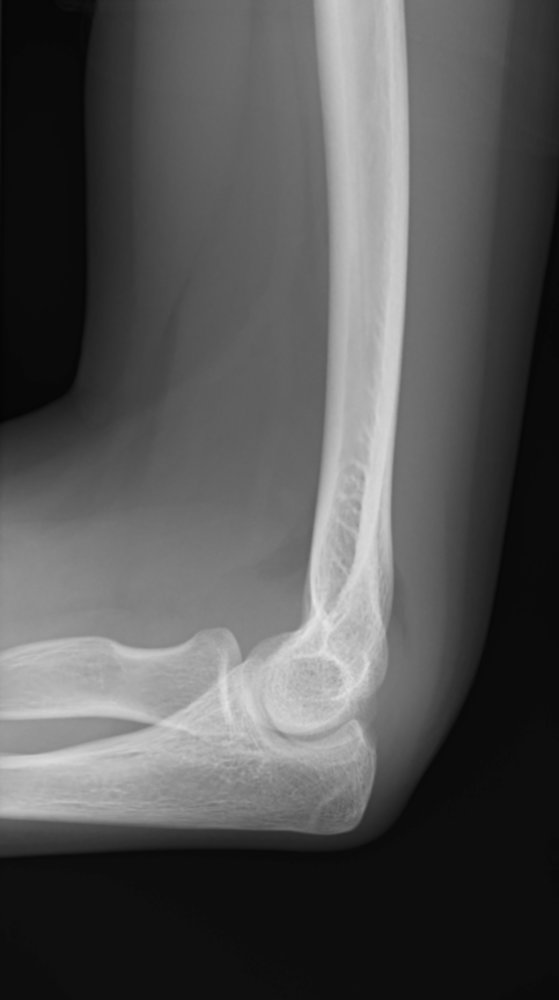 Anterior and posterior fat pad sign