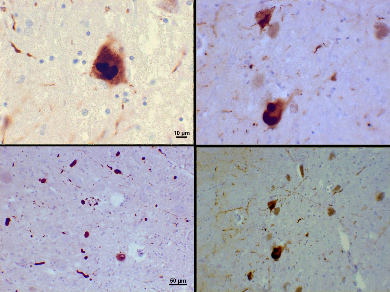 Lewy bodies and Lewy neurites