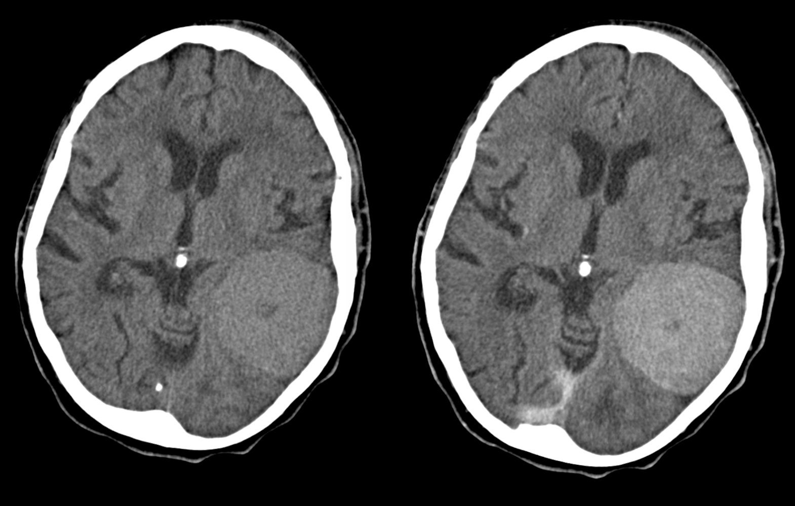Meningioma with central necrosis