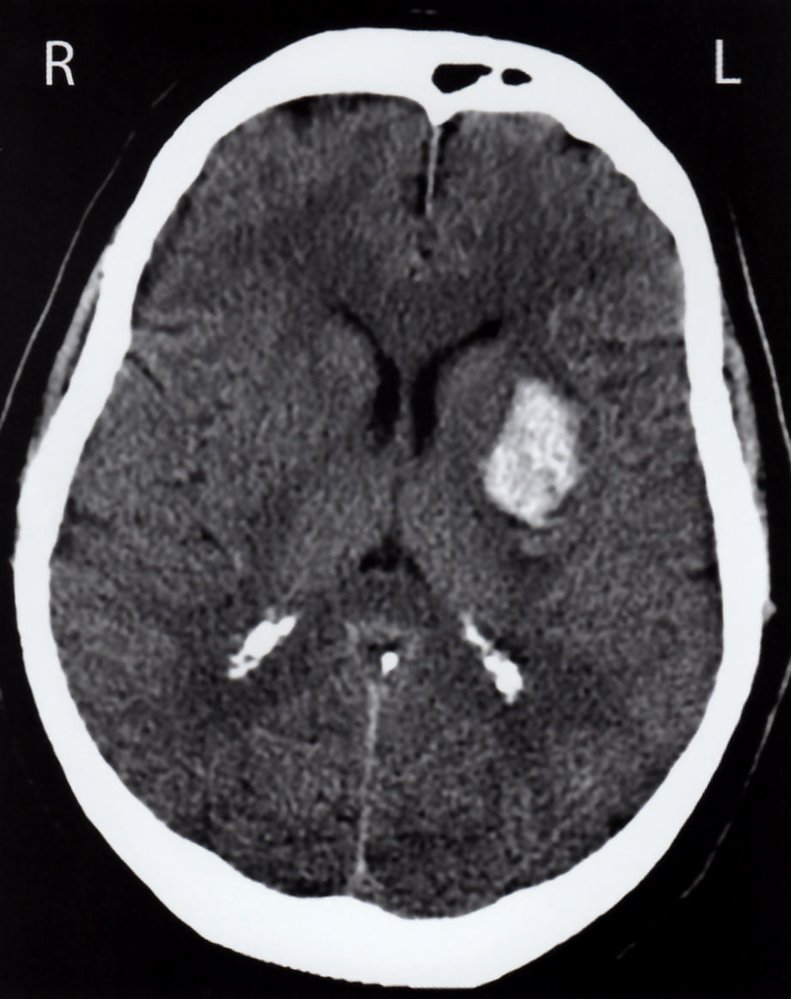 Basal ganglia hemorrhage