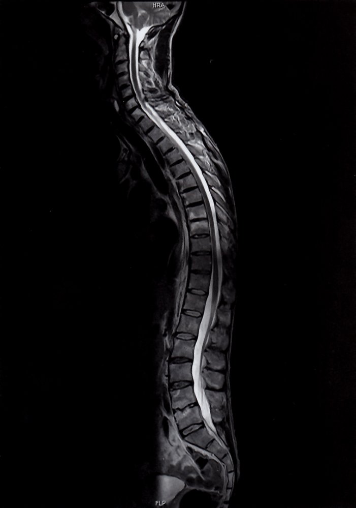 Ankylosing spondylitis