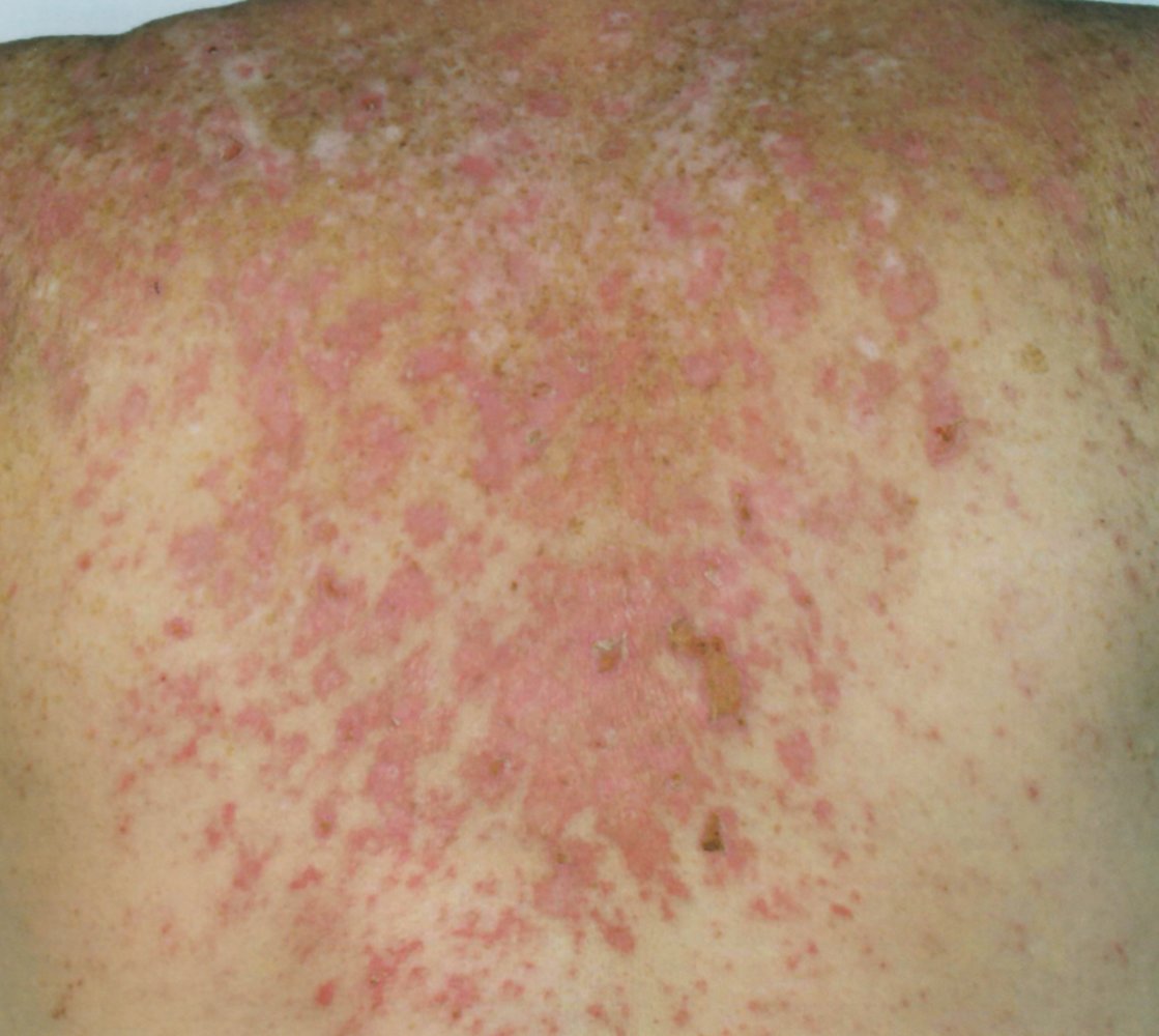 Subacute cutaneous lupus erythematosus