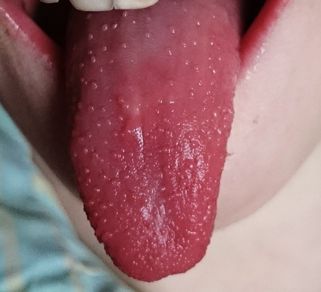 Strawberry tongue