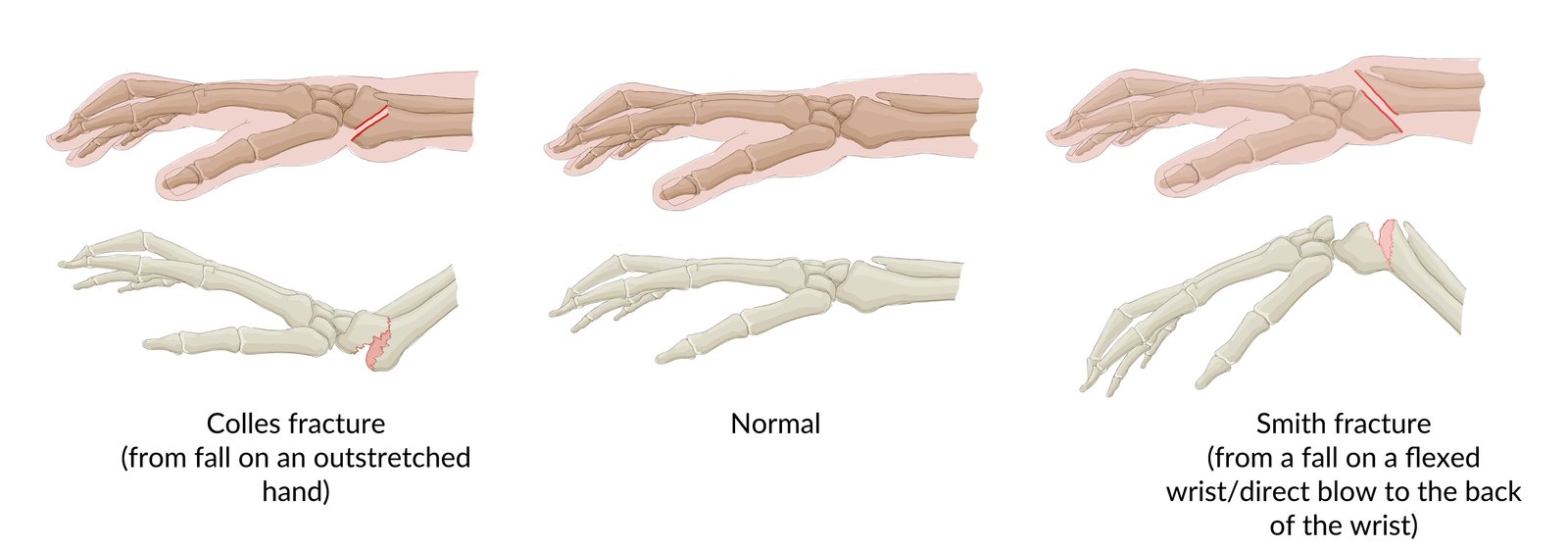 Distal radius fractures