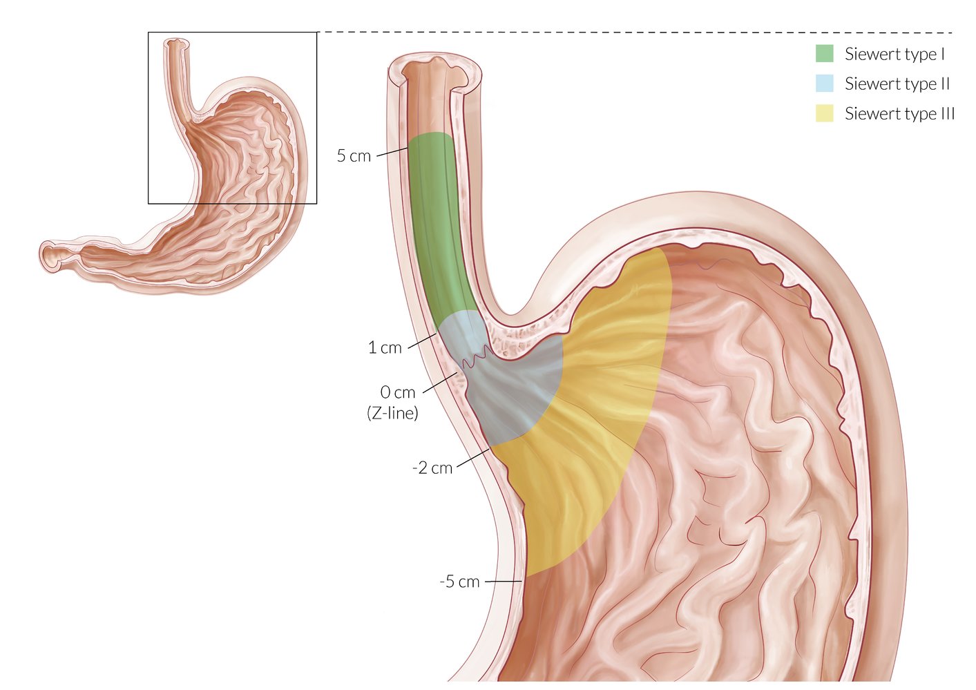Adenocarcinoma of the esophagogastric junction: Siewert classification