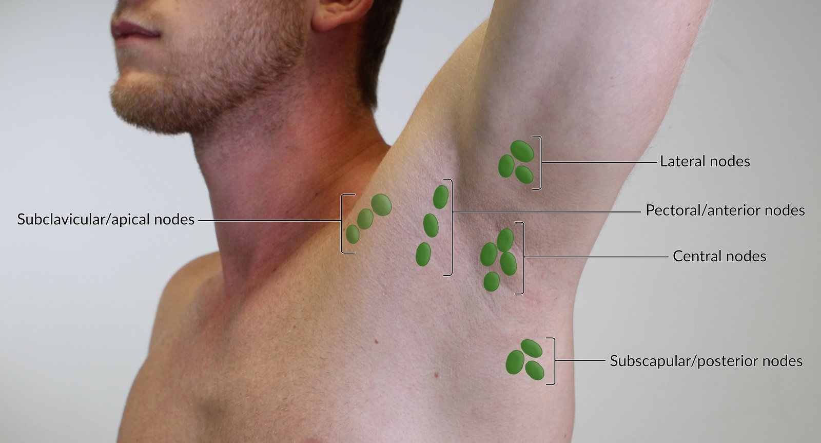 Palpable lymph nodes of the axillary region