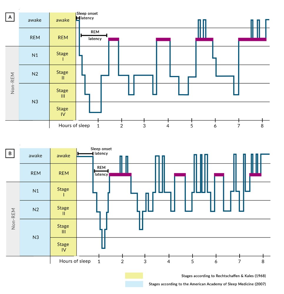Comparison of sleep phases in healthy and depressed individuals