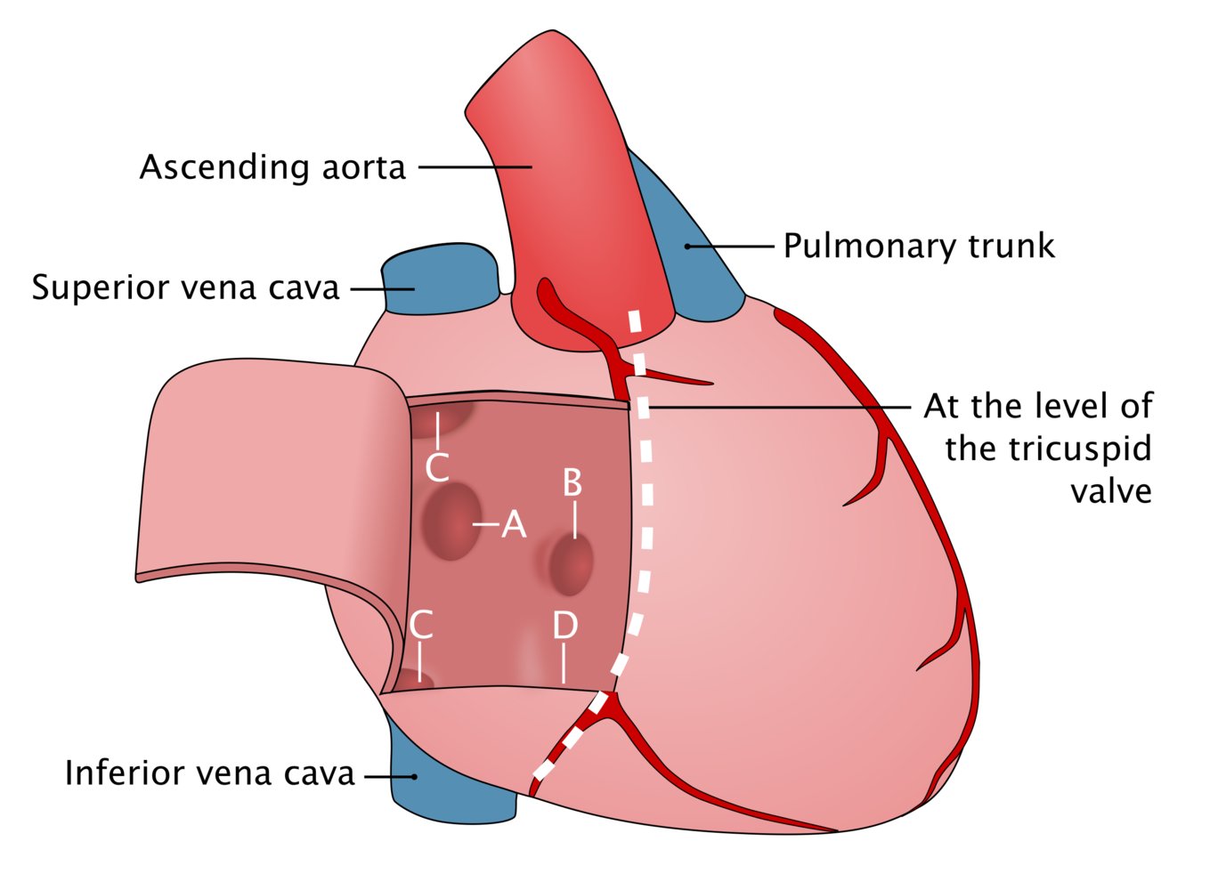 Types of atrial septal defects