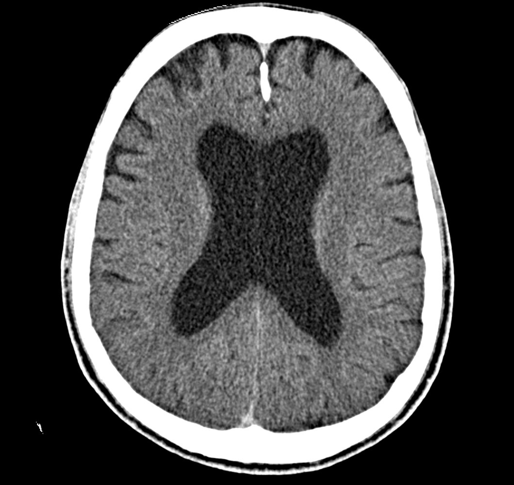 Hydrocephalus