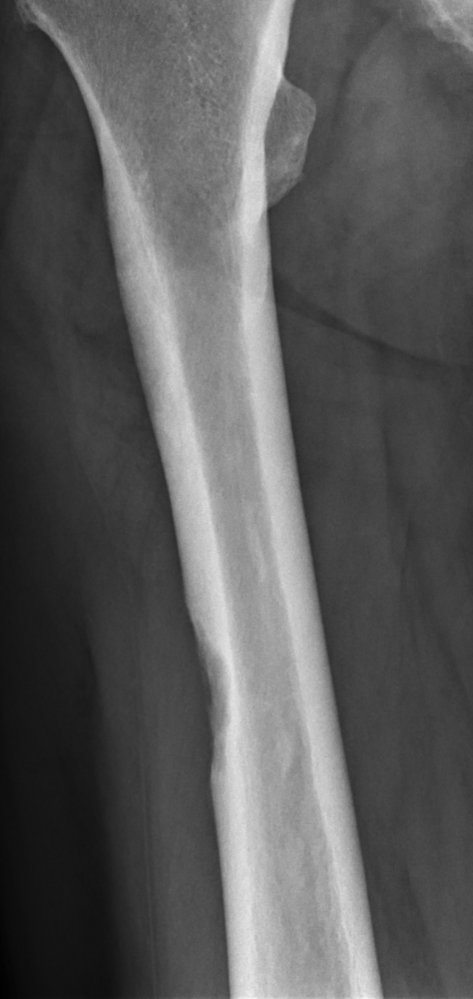 Osteolytic metastasis