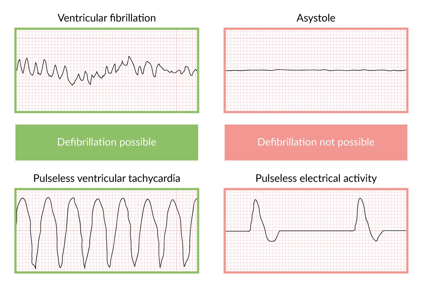 Rhythms in cardiopulmonary resuscitation