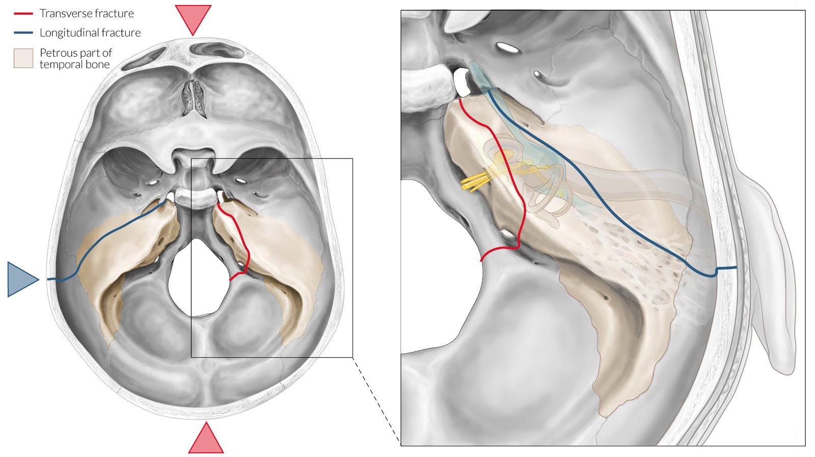 Longitudinal and transverse temporal bone fractures