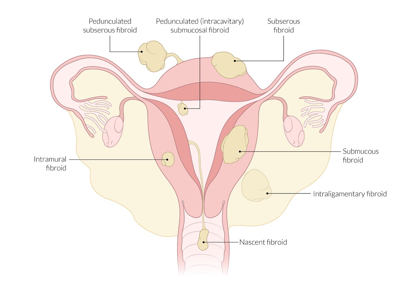 Overview of uterine leiomyoma types and location